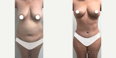 Case 11380 - Woman treated with Mommy Makeover