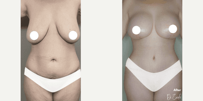 Case 11386 - Woman treated with Mommy Makeover