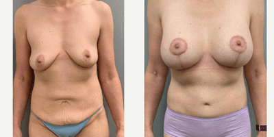 Case 11387 - 45-54 year old woman treated with Mommy Makeover