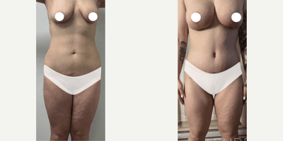 Case 11391 - Woman treated with Mommy Makeover