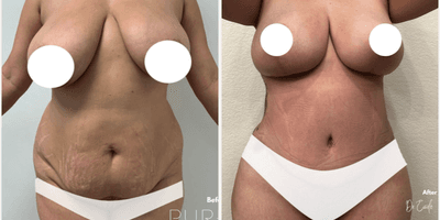 Case 11394 - Woman treated with Mommy Makeover