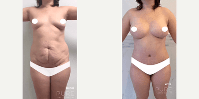 Case 11395 - Woman treated with Mommy Makeover