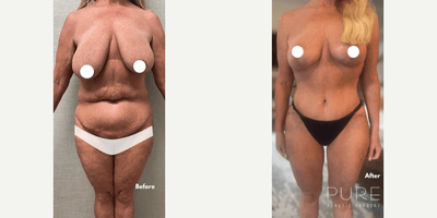 Case 11398 - Woman treated with Mommy Makeover