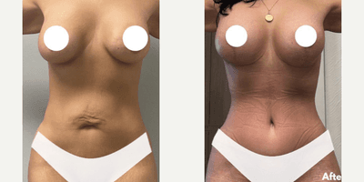 Case 11399 - Woman treated with Mommy Makeover