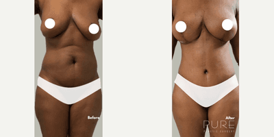 Case 11400 - Woman treated with Mommy Makeover