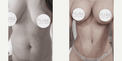 Case 11417 - Woman treated with Mommy Makeover