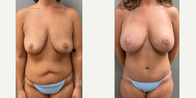 Case 11422 - 35-44 year old woman treated with Mommy Makeover