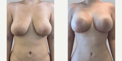 Case 11434 - Woman treated with Mommy Makeover