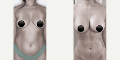 Case 11435 - Woman treated with Mommy Makeover