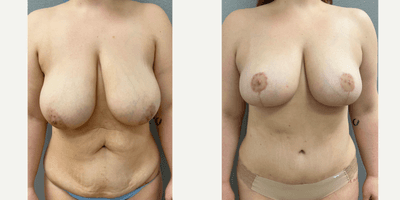 Case 11457 - 25-34 year old woman treated with Mommy Makeover