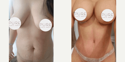 Case 11459 - Woman treated with Mommy Makeover