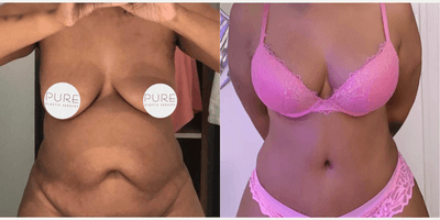 Case 11460 - Woman treated with Mommy Makeover