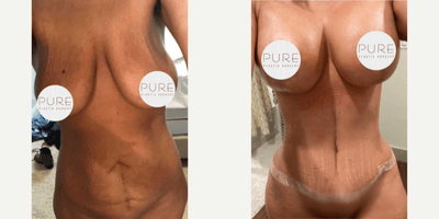 Case 11461 - Woman treated with Mommy Makeover