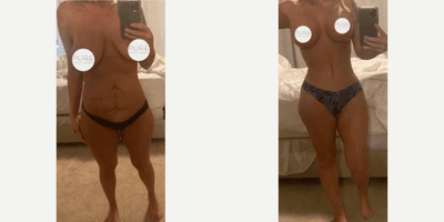 Case 11462 - Woman treated with Mommy Makeover