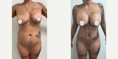 Case 11469 - Woman treated with Mommy Makeover