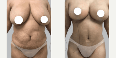 Case 11470 - Woman treated with Mommy Makeover