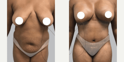 Case 11471 - Woman treated with Mommy Makeover