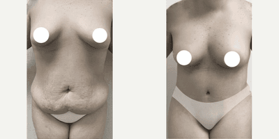 Case 11476 - 25-34 year old woman treated with Mommy Makeover