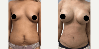 Case 11477 - Woman treated with Mommy Makeover