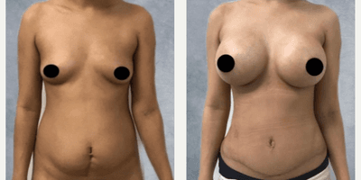 Case 11479 - Woman treated with Mommy Makeover