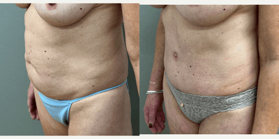 Case 1394 - 48 year old woman treated with Tummy Tuck
