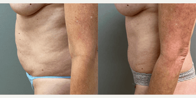 Case 1395 - 48 year old woman treated with Tummy Tuck