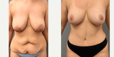 Case 1396 - 25-34 year old woman treated with Tummy Tuck
