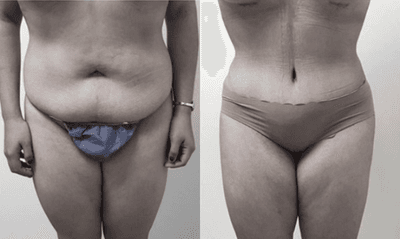 Case 1404 - 35-44 year old woman treated with Tummy Tuck