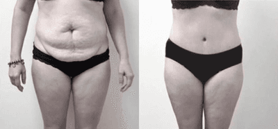 Case 1405 - 45-54 year old woman treated with Tummy Tuck