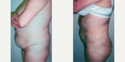 Case 1409 - 42 year old woman treated with Tummy Tuck