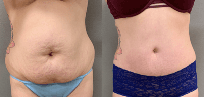 Case 1433 - 25-34 year old woman treated with Tummy Tuck