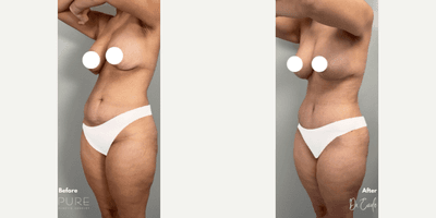 Case 1482 - Woman treated with Tummy Tuck 