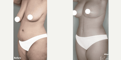 Case 1492 - Woman treated with Tummy Tuck