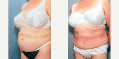 Case 1521 - Woman treated with Tummy Tuck