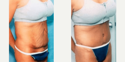 Case 1522 - Woman treated with Tummy Tuck