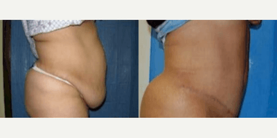 Case 1523 - Woman treated with Tummy Tuck