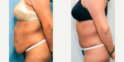 Case 1524 - Woman treated with Tummy Tuck