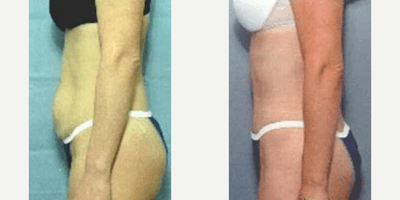 Case 1525 - Woman treated with Tummy Tuck