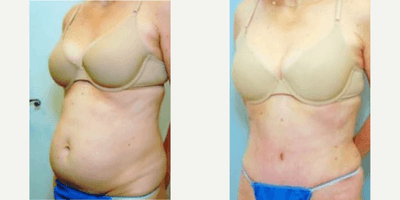 Case 1526 - 42 year old woman treated with Tummy Tuck