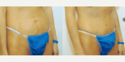 Case 1527 - Woman treated with Tummy Tuck