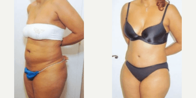 Case 1528 - Woman treated with Tummy Tuck