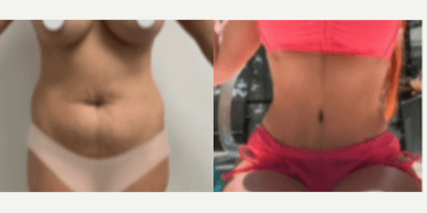 Case 153 - Woman treated with Tummy Tuck