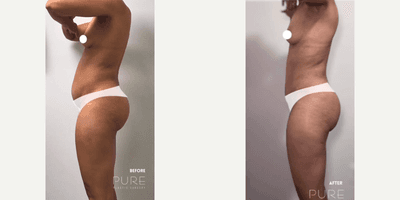 Case 1571 - Woman treated with Tummy Tuck