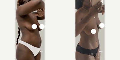 Case 1585 - Woman treated with Tummy Tuck