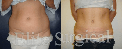 Case 1647 - Woman treated with Tummy Tuck