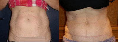 Case 1680 - Woman treated with Tummy Tuck