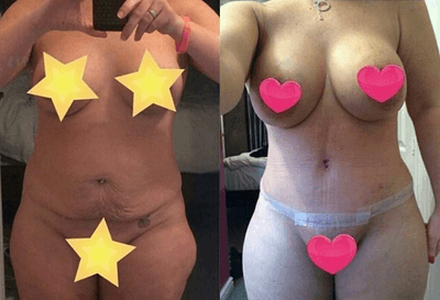 Case 1681 - Woman treated with Tummy Tuck