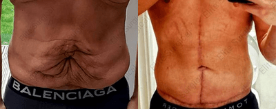 Case 1682 - Man treated with Tummy Tuck