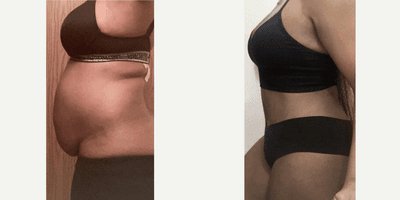 Case 1683 - Woman treated with Tummy Tuck