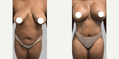 Case 174 - Woman treated with Tummy Tuck